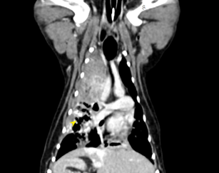 狗狗 肺臟腫瘤 Pulmonary carcinoma
