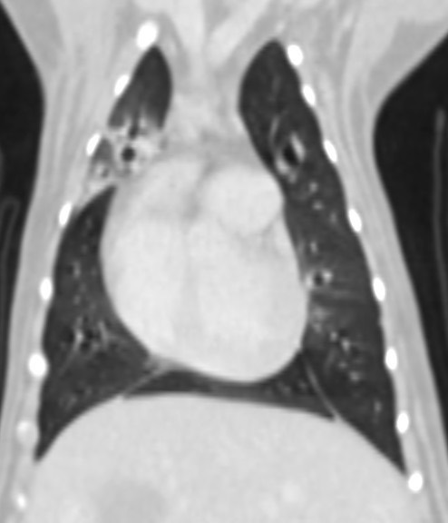 慢性咳嗽 支氣管肺炎 綠膿桿菌 電腦斷層掃描
