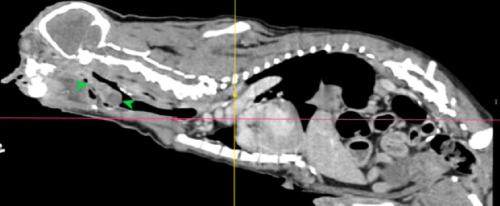 喉頭團塊 呼吸困難 急診