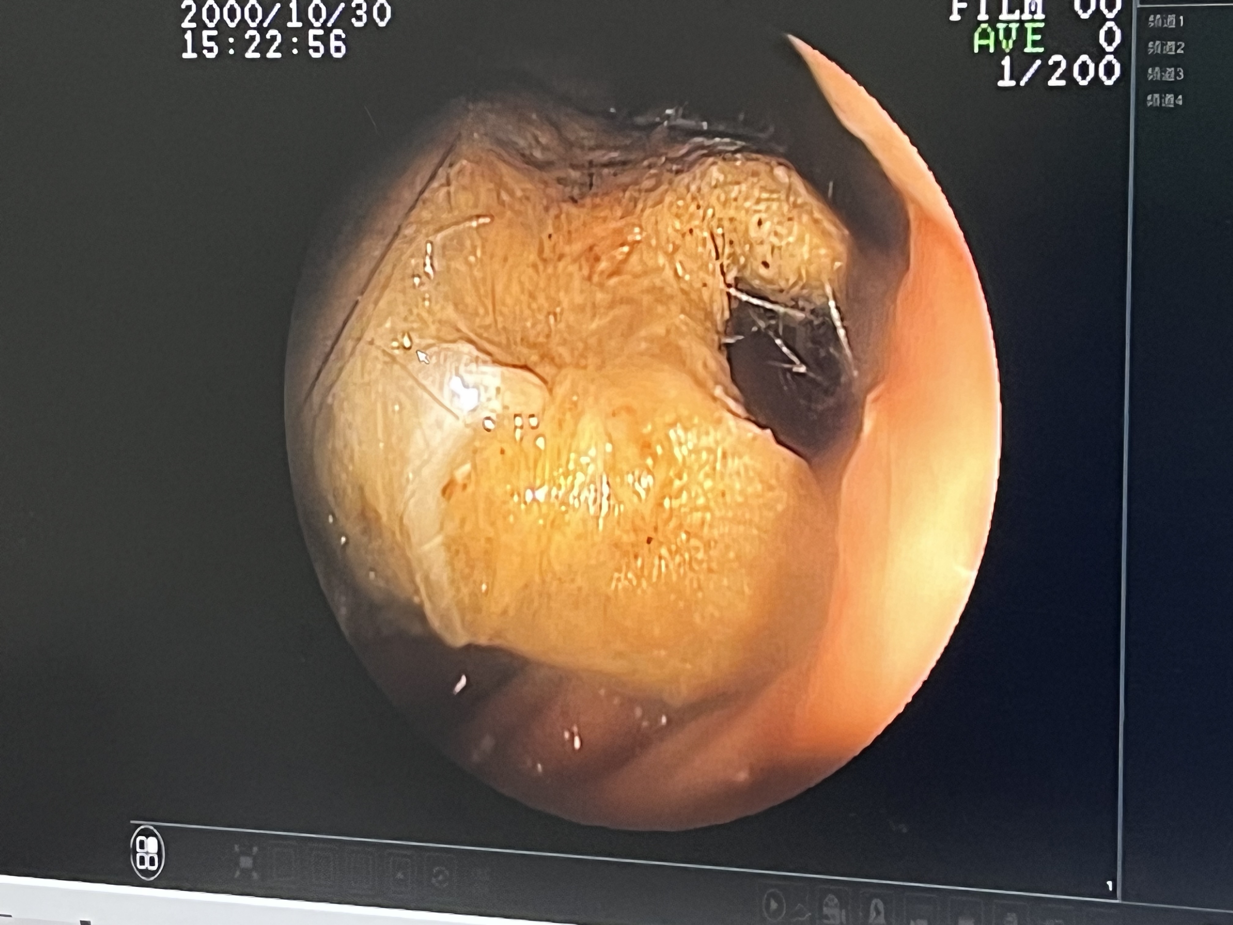 過年急診消化道異物
