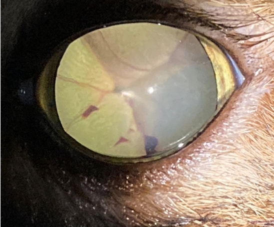 高血壓性視網膜病變